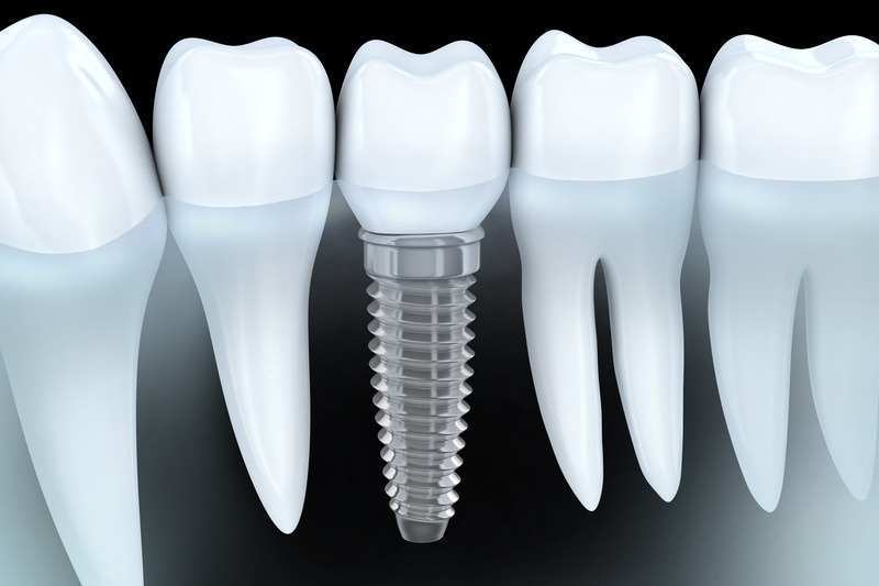 How to identify an unknown implant?