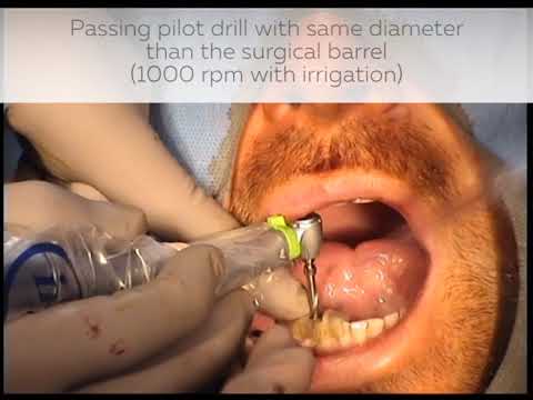 Mandibular and maxillary implant placement with an associated digital surgical guide
