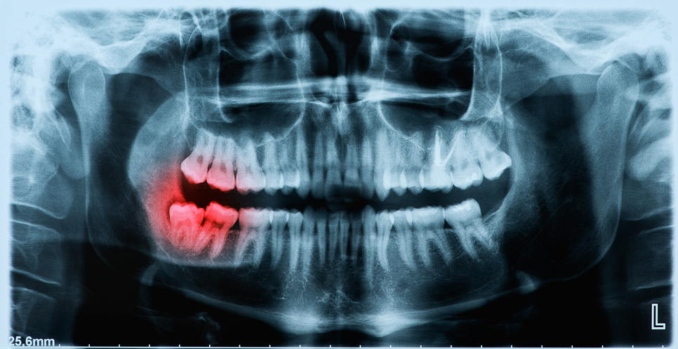 Periodontitis in twins: smoking, microbiological and immunological aspects Periodontitis in twins: smoking, microbiological and immunological aspects