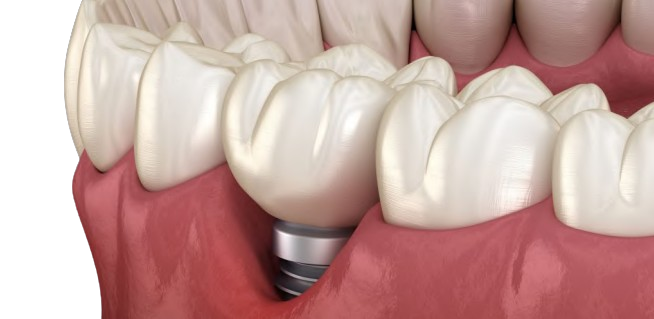 Periimplantitis: Prävention und Behandlung